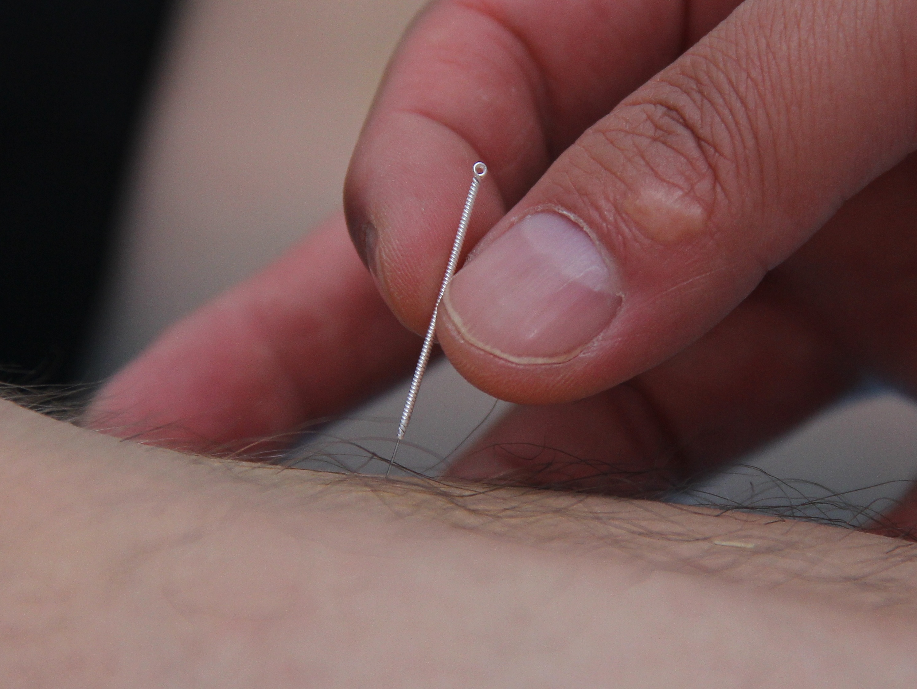 新乡潘氏脑病，针灸图